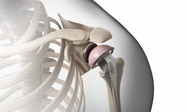 Мөрний хиймэл үе солих мэс засал image1