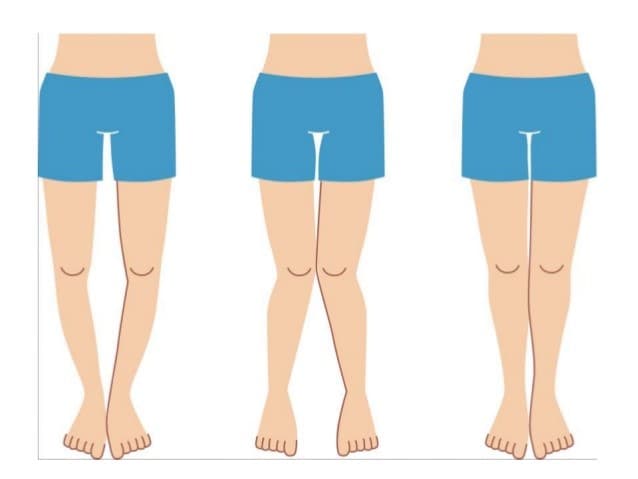 Хөлийн тэнхлэг засах мэс засал image2