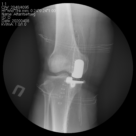 Өвдөгний үе хагас солих мэс засал (UKA) image4