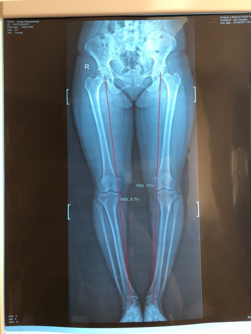 Хөлийн тэнхлэг засах мэс засал image5