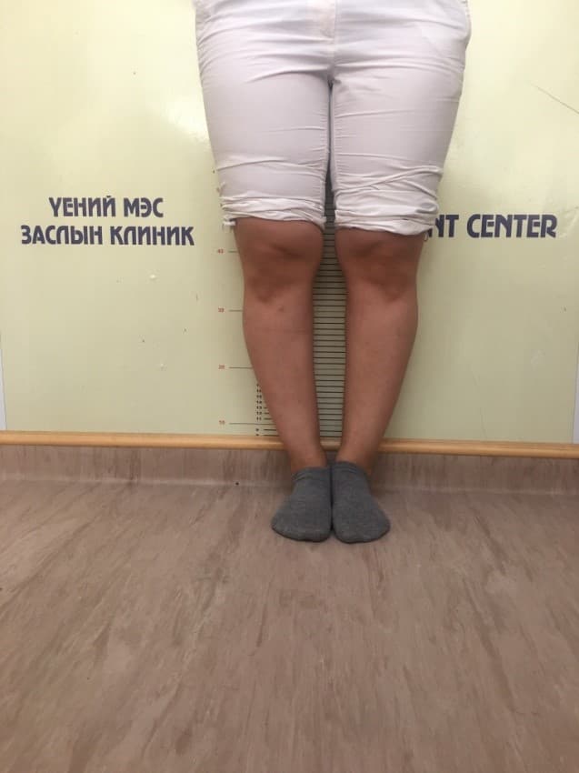 Хөлийн тэнхлэг засах мэс засал image7