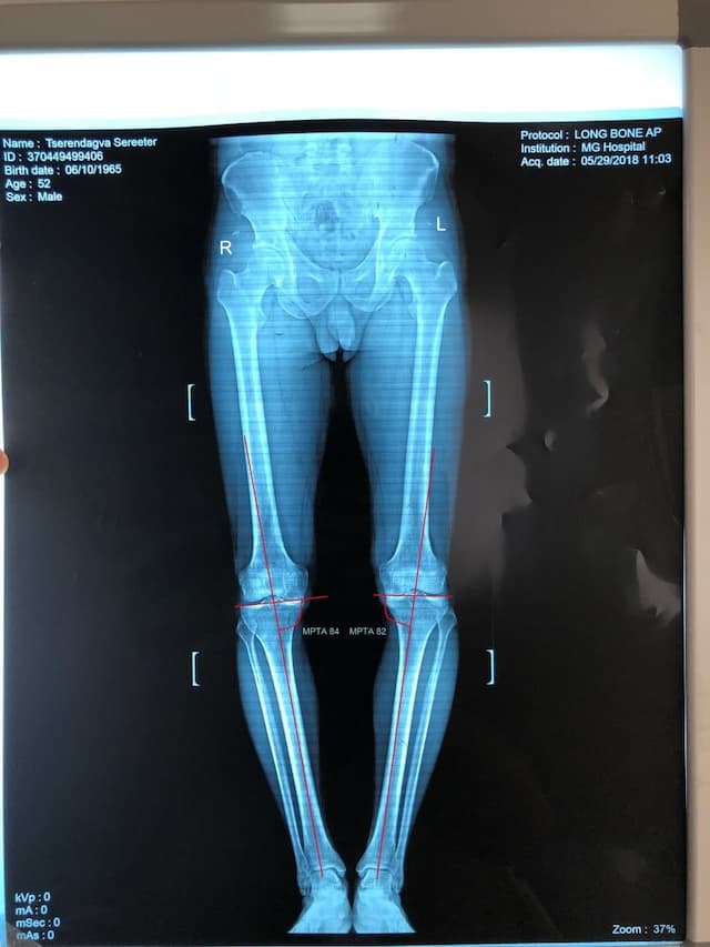 Хөлийн тэнхлэг засах мэс засал image9