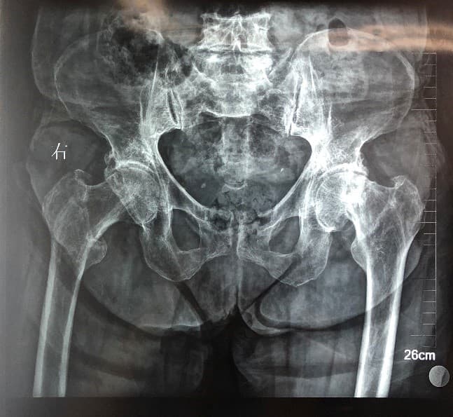 Түнхний үе хагас солих мэс засал (Bipolar Hip QRL) image1