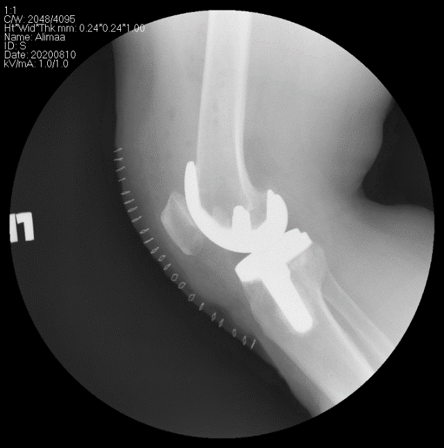 Өвдөгний үе бүтэн солих мэс засал (TKA) image10