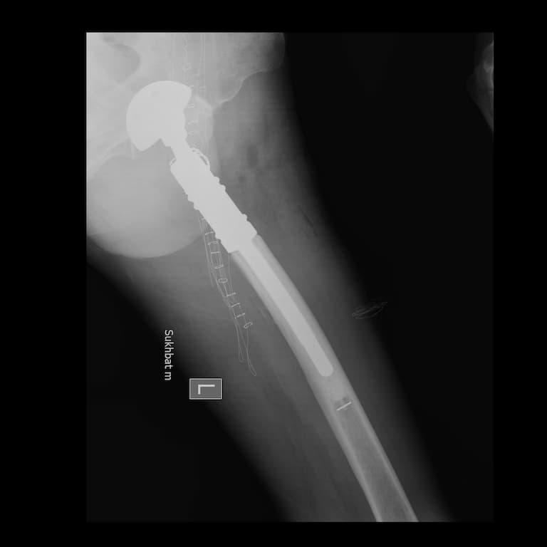 Түнхний үе солих мэс засал гэж юу вэ image10