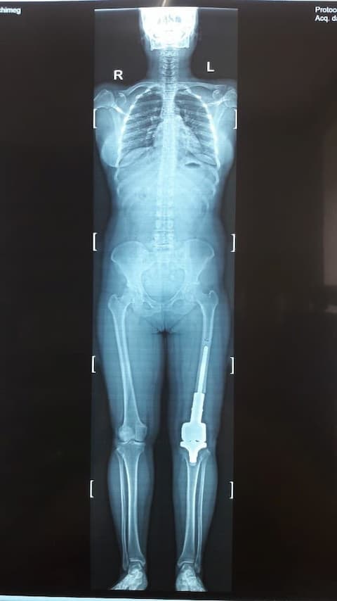 Үе дайрсан ясны анхдагч хавдар, ясны дутмагшлын үед хийгдэх мэс засалimage11