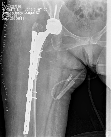 Хугарал засах мэс засал image11