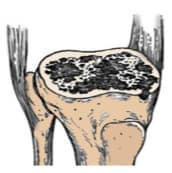 Үе дайрсан ясны анхдагч хавдар, ясны дутмагшлын үед хийгдэх мэс засалimage12