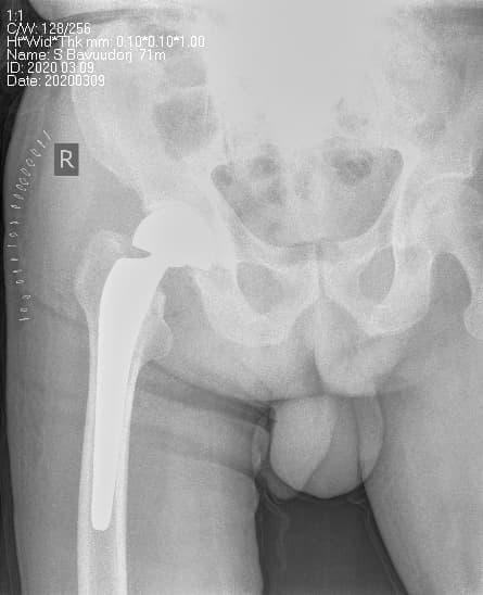 Түнхний үе солих мэс засал гэж юу вэ image14