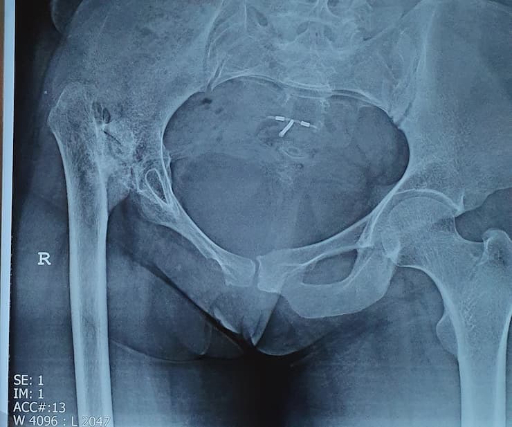 Түнхний үе солих мэс засал гэж юу вэ image16