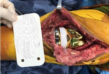 Үе дайрсан ясны анхдагч хавдар, ясны дутмагшлын үед хийгдэх мэс засалimage19