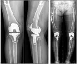 Өвдөгний үе бүтэн солих мэс засал (TKA) image2