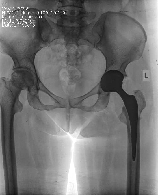 Түнхний үе бүтэн солих мэс засал (THA) image2