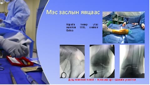 Хөлийн тэнхлэг засах мэс засал image2