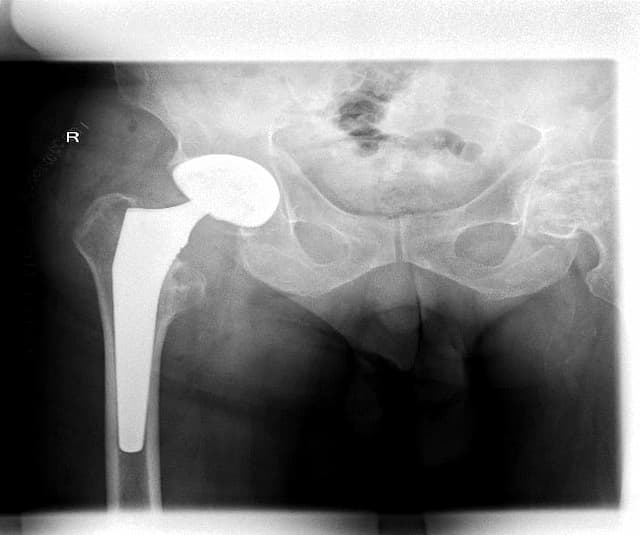 Түнхний үе хагас солих мэс засал (Bipolar Hip QRL) image2