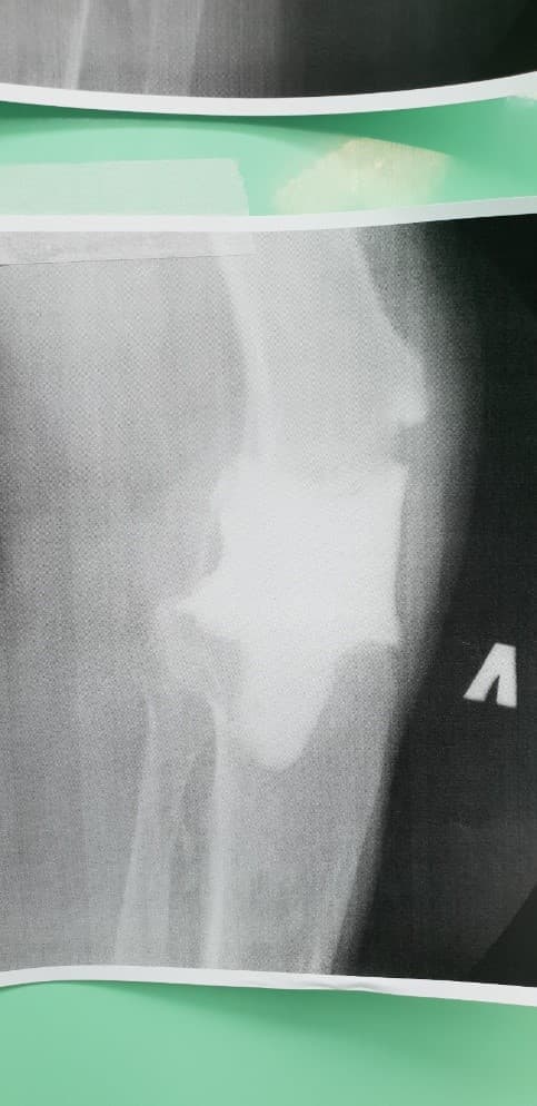 Үе дайрсан ясны анхдагч хавдар, ясны дутмагшлын үед хийгдэх мэс засалimg23