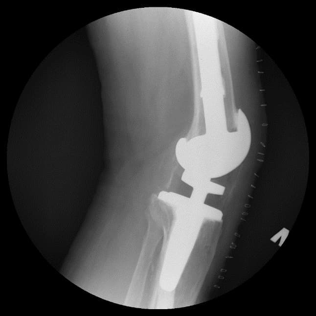 Үе дайрсан ясны анхдагч хавдар, ясны дутмагшлын үед хийгдэх мэс засалimg25