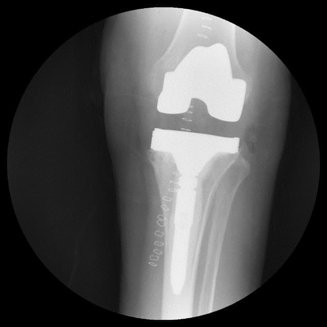 Үе дайрсан ясны анхдагч хавдар, ясны дутмагшлын үед хийгдэх мэс засалimg29