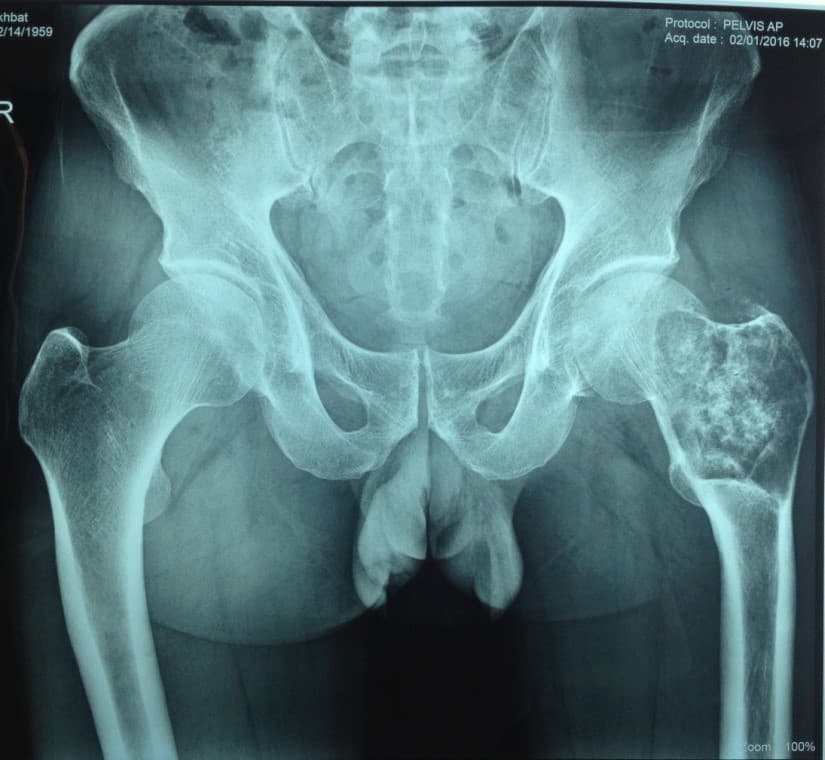 Үе дайрсан ясны анхдагч хавдар, ясны дутмагшлын үед хийгдэх мэс засал image3