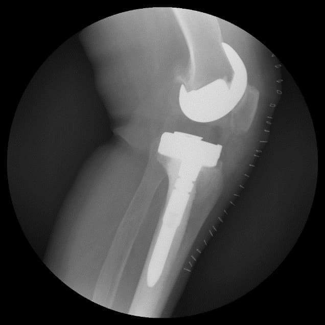 Үе дайрсан ясны анхдагч хавдар, ясны дутмагшлын үед хийгдэх мэс засалimg30