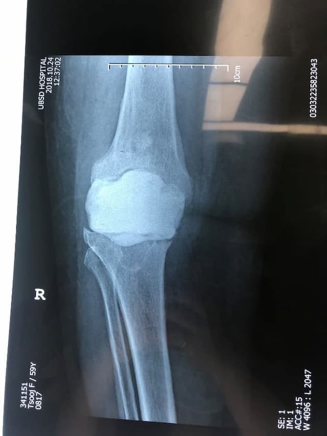 Үе дайрсан ясны анхдагч хавдар, ясны дутмагшлын үед хийгдэх мэс засалimg31