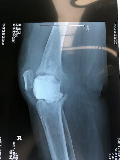 Үе дайрсан ясны анхдагч хавдар, ясны дутмагшлын үед хийгдэх мэс засалimg32