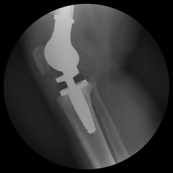 Үе дайрсан ясны анхдагч хавдар, ясны дутмагшлын үед хийгдэх мэс засалimg35