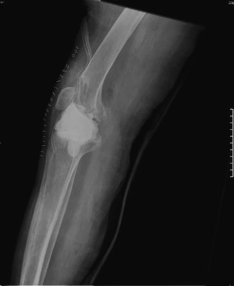 Үе дайрсан ясны анхдагч хавдар, ясны дутмагшлын үед хийгдэх мэс засалimg38