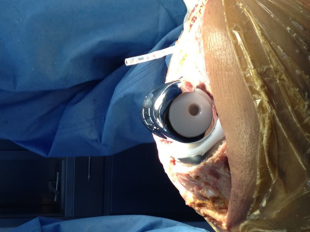 Үе дайрсан ясны анхдагч хавдар, ясны дутмагшлын үед хийгдэх мэс засалimage39