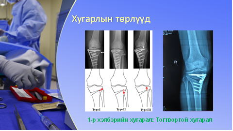 Хөлийн тэнхлэг засах мэс засал image4