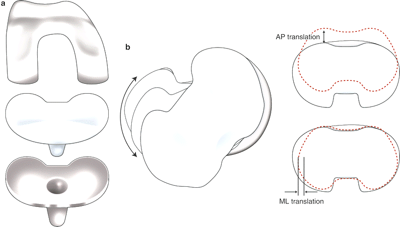 Өвдөгний үе бүтэн солих мэс засал (TKA) image4