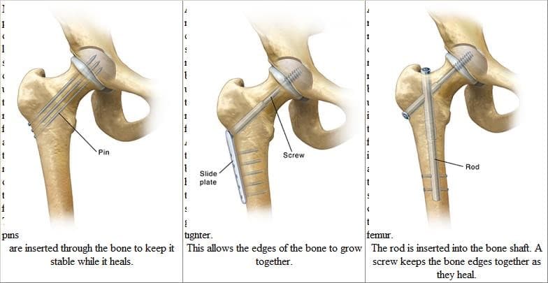 Хугарал засах мэс засал image4
