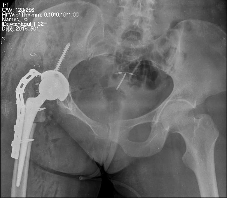 Түнхний үе бүтэн солих мэс засал (THA) image4