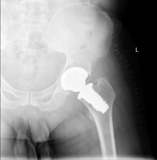 Түнхний үе бүтэн солих мэс засал (THA) image5