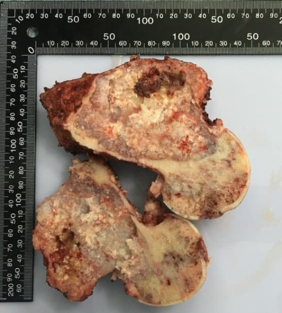 Үе дайрсан ясны анхдагч хавдар, ясны дутмагшлын үед хийгдэх мэс засалimage5