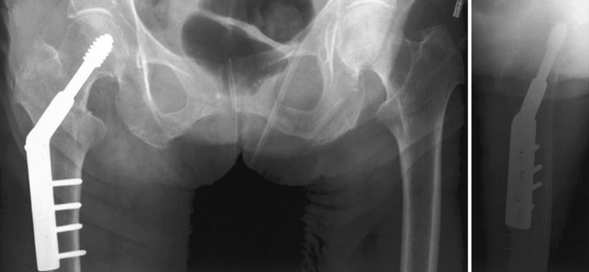 Хугарал засах мэс засал image5