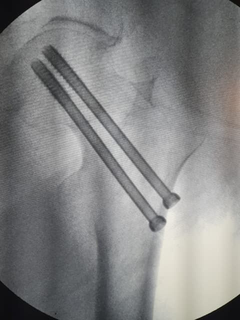 Хугарал засах мэс засал image6