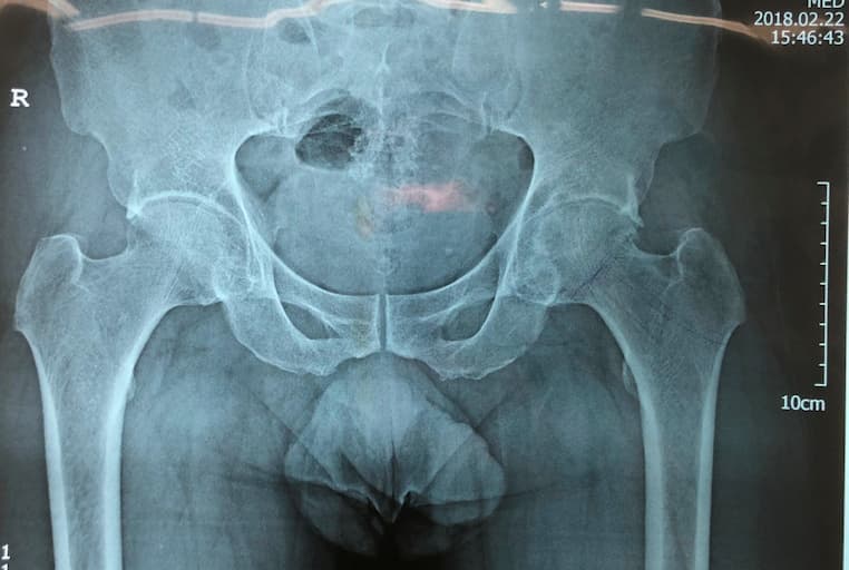 Түнхний үе бүтэн солих мэс засал (THA) image6