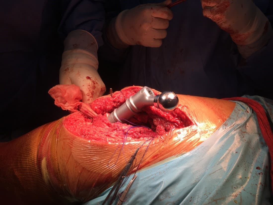 Үе дайрсан ясны анхдагч хавдар, ясны дутмагшлын үед хийгдэх мэс засалimage6