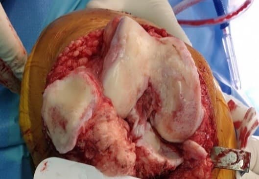 Өвдөгний үе бүтэн солих мэс засал (TKA) image7