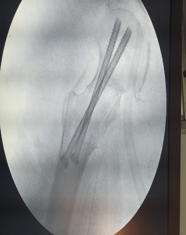 Хугарал засах мэс засал image7