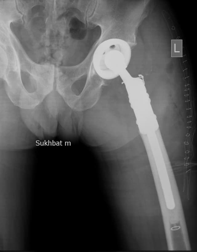 Үе дайрсан ясны анхдагч хавдар, ясны дутмагшлын үед хийгдэх мэс засалimage7