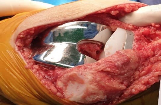 Өвдөгний үе бүтэн солих мэс засал (TKA) image8