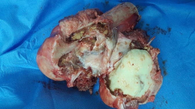 Үе дайрсан ясны анхдагч хавдар, ясны дутмагшлын үед хийгдэх мэс засалimage8