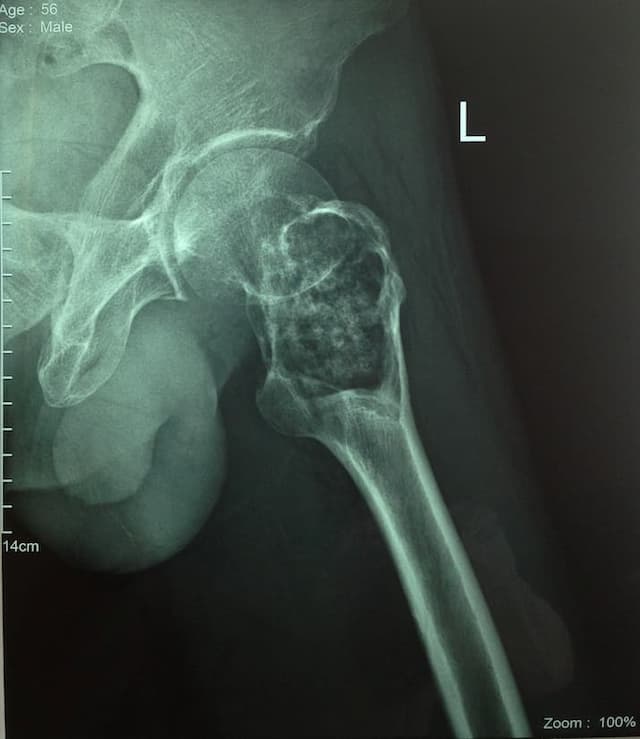 Түнхний үе бүтэн солих мэс засал (THA) image8