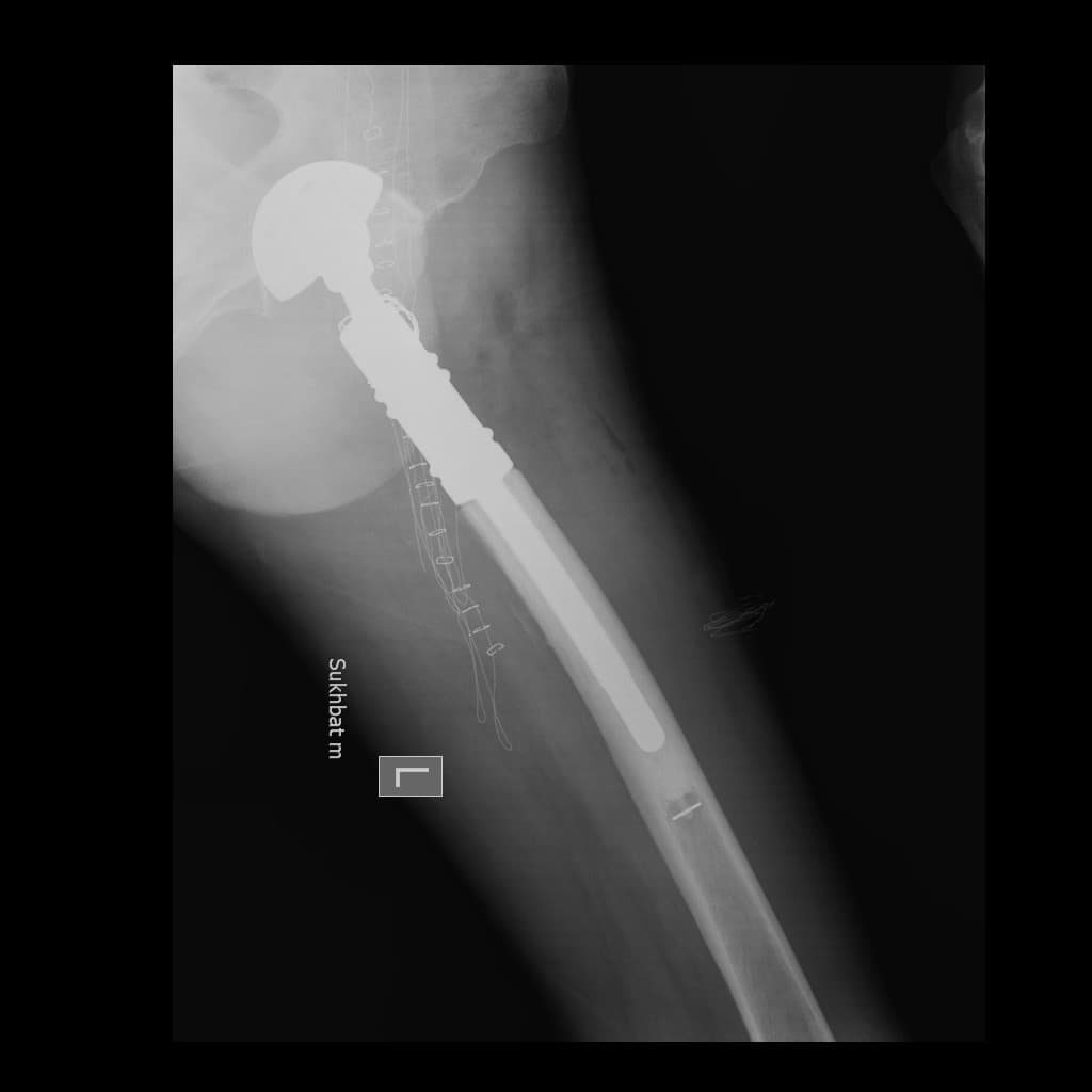 Түнхний үе бүтэн солих мэс засал (THA) image9